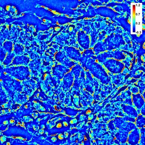 SLIM image of prostate cancer biopsy