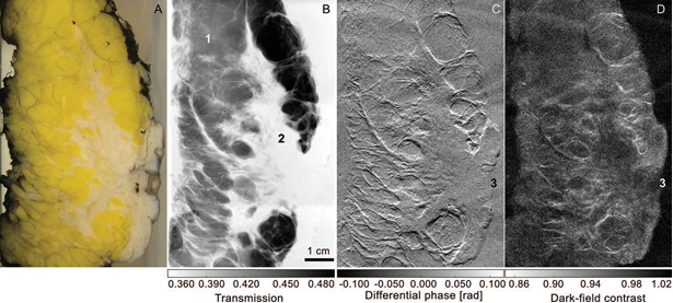 Breast cancer diagnosis using Lyncean compact light source